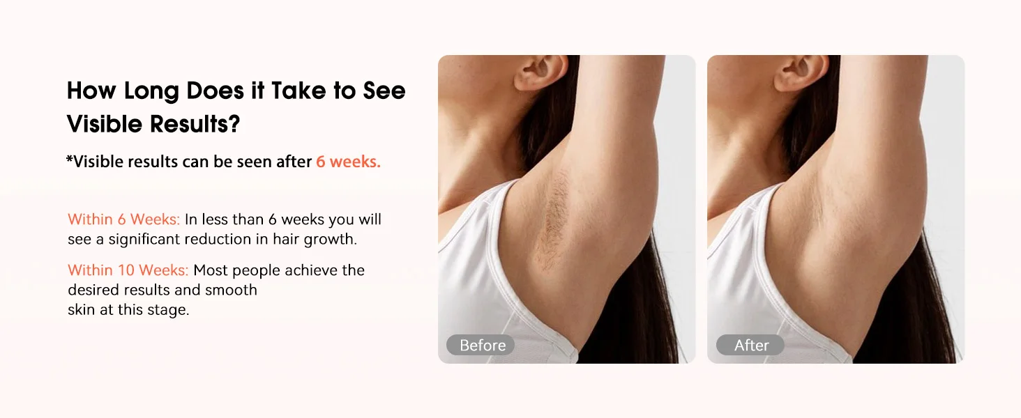 IPL Devices Hair Removal Laser 17J 999900 Light Pulses HR/SC/RA 9 Levels Whole Body Painless Hair Removal Home Use For Men Women 13 kf S17816eb4bfd14d84bc348b3b5a1b1b272